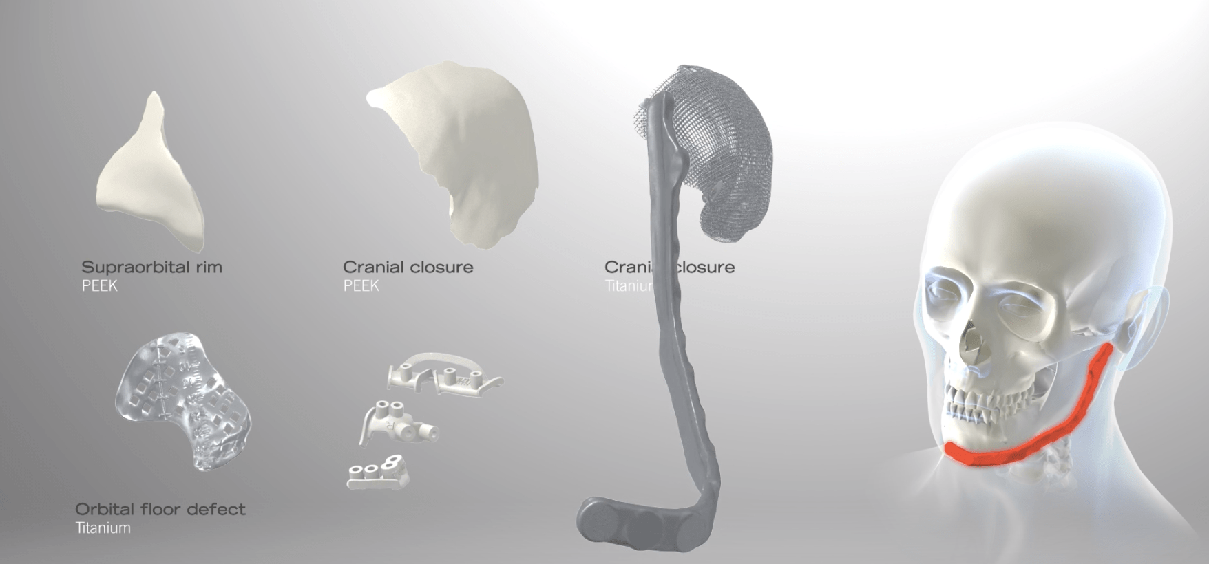 Individual patient solutions by KLS Martin