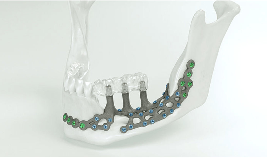 IPS Implants Preprosthetic (KLS Martin)